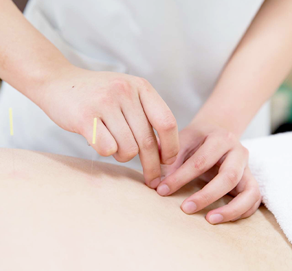 a woman performing accupuncture